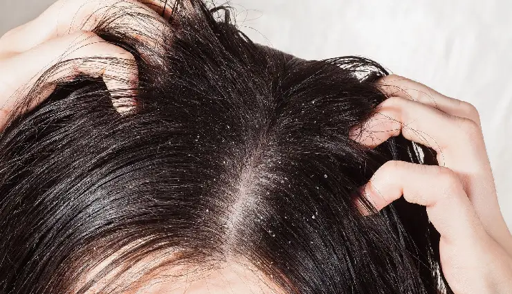 5 DIY Ways To Treat Dry Scalp and Oily Hair