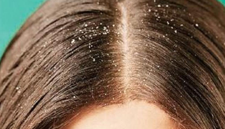 dry scalp,home remedies,home remedies to treat dry scalp,hair care tips,beauty tips
