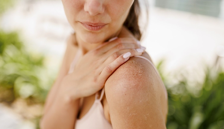 aloe vera for sunburn,sunburn relief,natural sunburn remedy,soothe sun-damaged skin,aloe vera benefits,summer skincare,sunburn treatment at home,cooling gel for burns,sun care tips,aloe vera healing properties