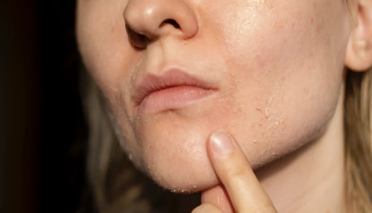 8 Effective Home Remedies To Treat Dry Skin