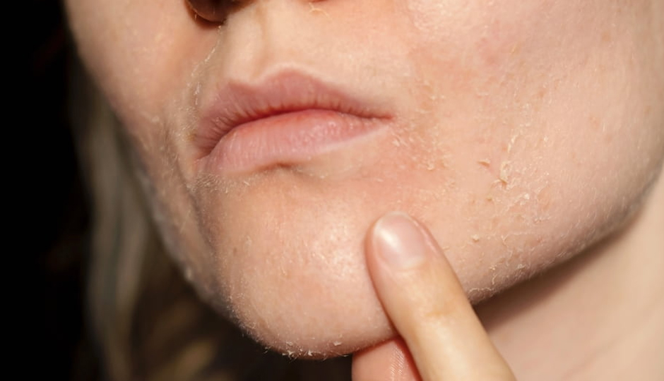 7 DIY Ways To Treat Dry Skin Around Lips