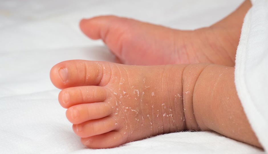 10 Home Remedies to Treat Dry Skin in Babies