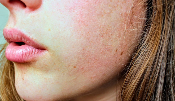 DIY: Nourishing Avocado And Yogurt Face Pack For Dry Skin