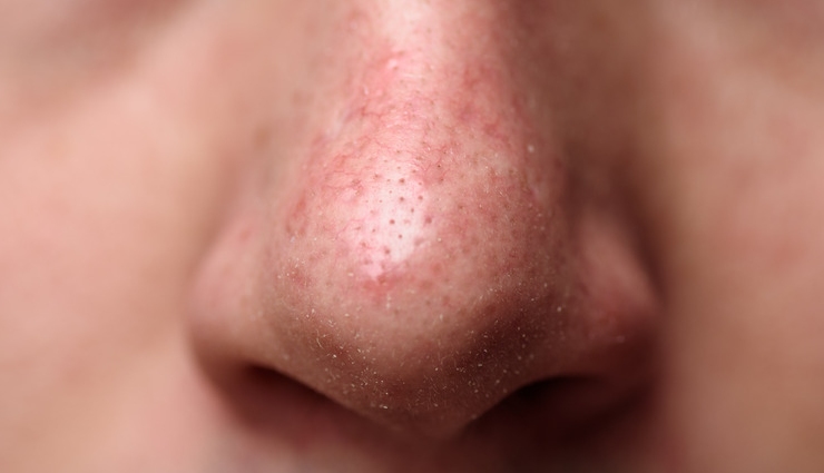 7 Remedies To Treat Dry Skin Around Nose