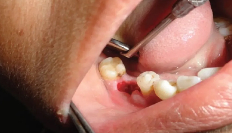 19 Best Possible Remedies To Try for Dry Socket