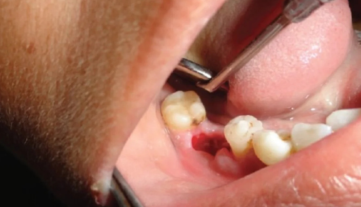 10 Home Remedies You Can Try To Treat Pain Due To Dry Socket