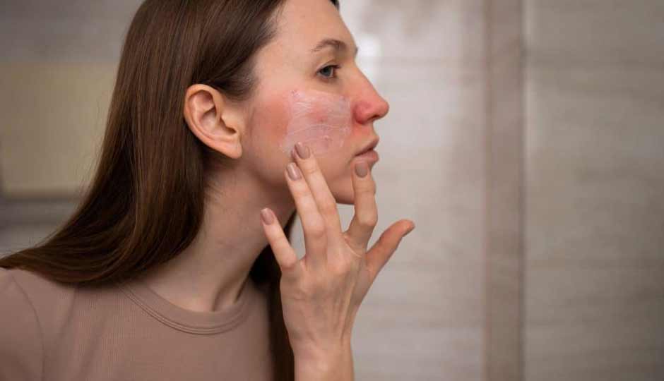 10 Home Remedies to Treat Dryness on Face During Monsoon