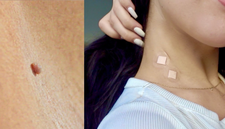 skin tags,home remedies to treat skin tags,skin care,skin beauty,skin care tips,beauty tips