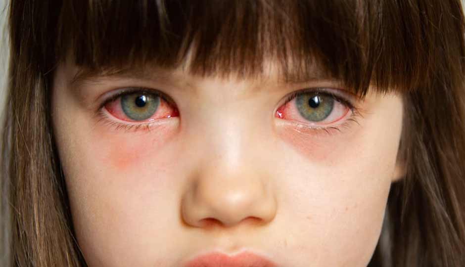 12 Effective Home Remedies to Treat Dust Allergy in Eyes