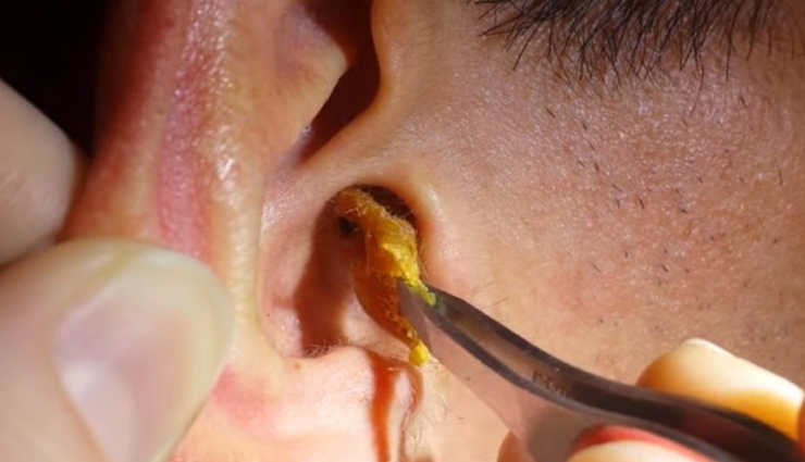 5 Effective Home Remedies To Remove Earwax