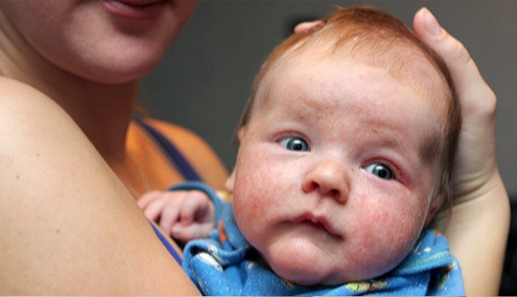 5 Remedies To Treat Eczema in Babies Naturally
