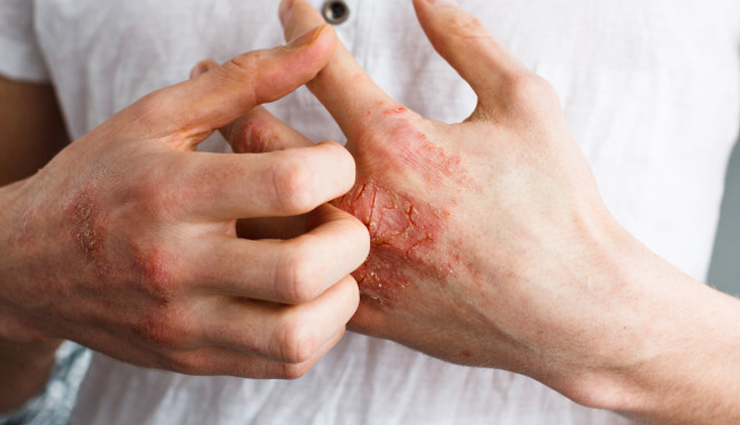 Homemade Lotion Bar To Treat Eczema