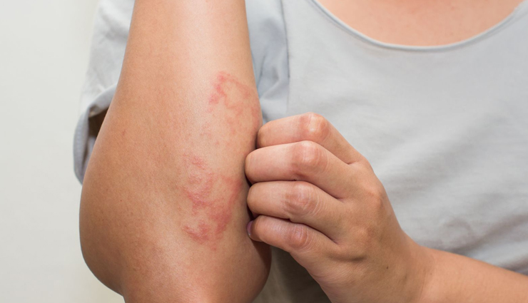 6 Remedies To Prevent Eczema in Winters