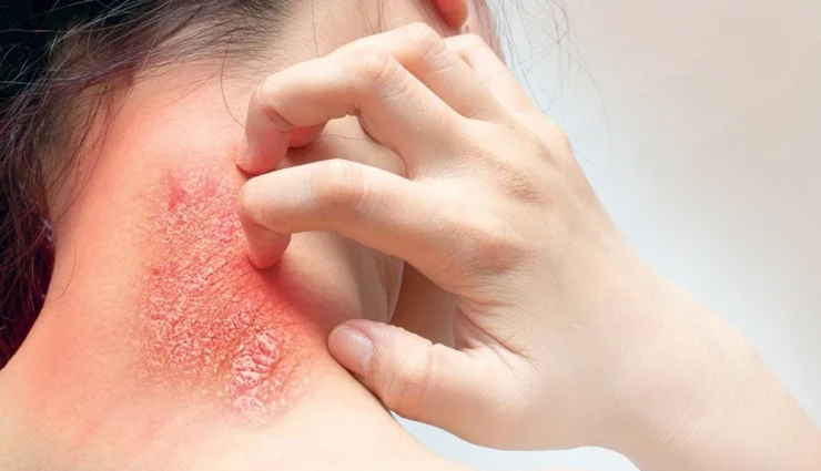 natural remedies for eczema,home remedies for eczema treatment,eczema treatment at home,natural ways to treat eczema,home remedies for itchy skin,natural remedies for dry skin,eczema relief at home,home remedies for skin rashes,natural remedies for skin inflammation,home remedies for eczema flare-ups