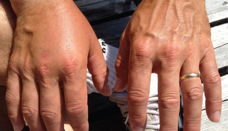 5 Home Remedies to treat Edema (Swelling in Body)