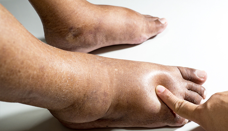 chronic kidney disease,sign of chronic kidney disease,symptoms of chronic kidney disease,kidney disease,kidney health,Health,Health tips