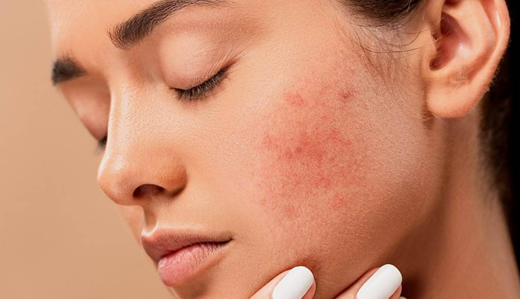 egg mask,beauty benefits of egg mask,skin care tips,beauty tips