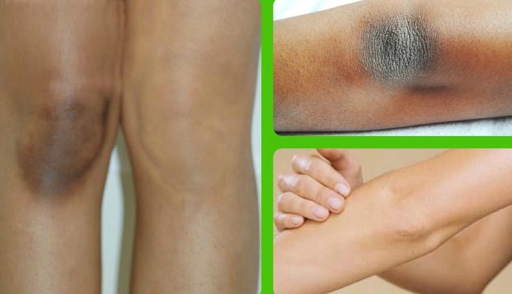 कोहनी और घुटने के कालेपन से निजात दिलाएँगे ये उपाय, जल्दी ही दिखने लगेगा असर