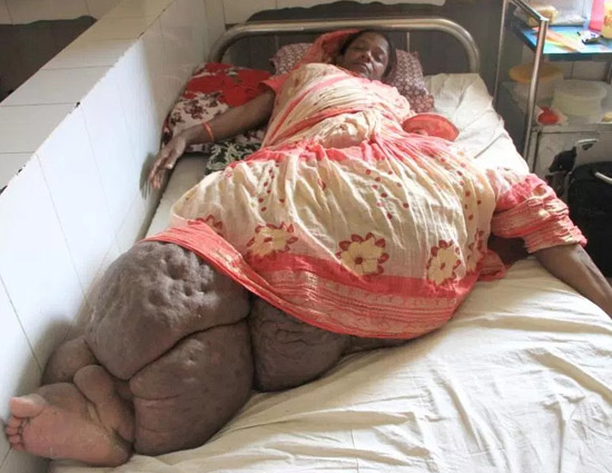 मच्छर के काटने से देखतें ही देखतें इस महिला का पैर हो गया 60 Kg का 