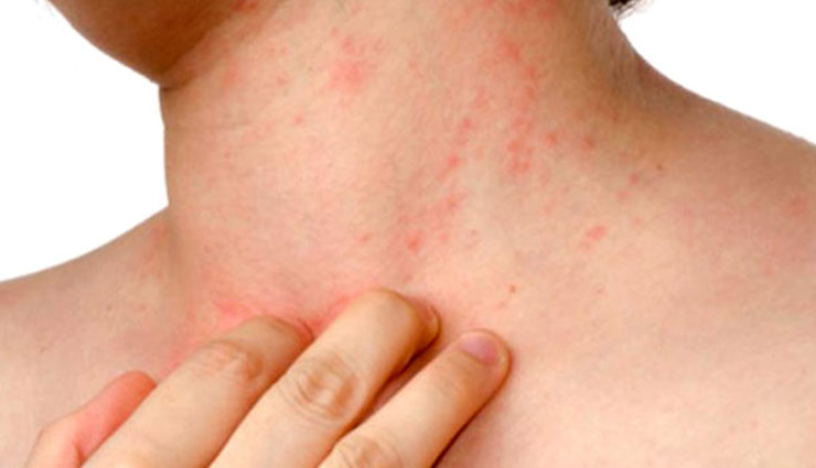 beauty tips,tips to remove skin allergy,home remedies,healthy skin