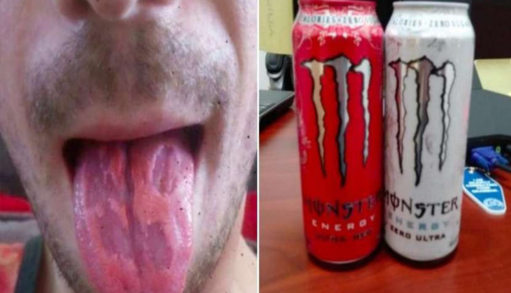 एनर्जी ड्रिंक पीने की वजह से शख्स की जीभ का हुआ बुरा हाल, सोशल मीडिया पर बयाँ किया अपना दर्द