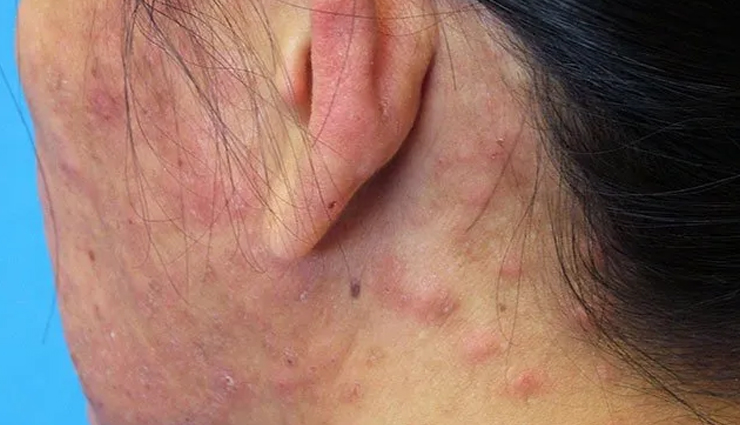 scalp scabs treatment,treating scabs on the scalp,get rid of scalp scabs,home remedies for scalp scabs,scalp care tips,scab removal methods,scalp health advice,healing scalp sores,natural remedies for scalp scabs,preventing scalp scabs