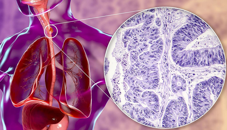 esophageal cancer warning signs,causes of esophageal cancer,early symptoms of esophageal cancer,recognizing esophageal cancer indicators,esophageal cancer risk factors,understanding esophageal cancer causes,signs and causes of esophageal cancer,esophageal cancer diagnosis and symptoms,prevention and awareness of esophageal cancer,esophageal cancer screening recommendations