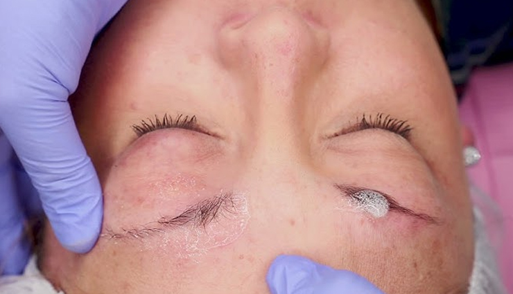 eyebrow dandruff remedies,get rid of eyebrow flakes,home remedies for eyebrow dandruff,eyebrow seborrheic dermatitis treatment,natural treatments for eyebrow dandruff,stop flaky eyebrows,tips to remove eyebrow dandruff