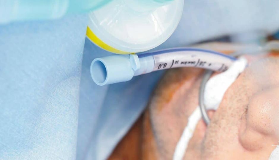Benefits of Risk Associated With Extubation