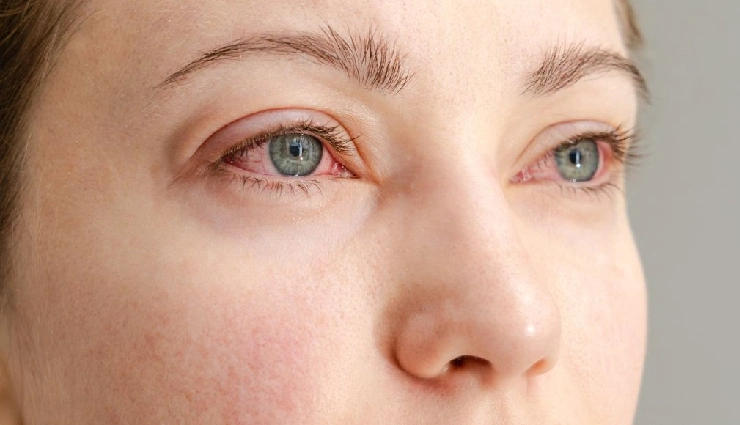 monsoon eye care,conjunctivitis prevention,pink eye monsoon,eye infection rainy season,eye hygiene tips,rainy season health,pink eye causes,avoid eye infections,conjunctivitis symptoms