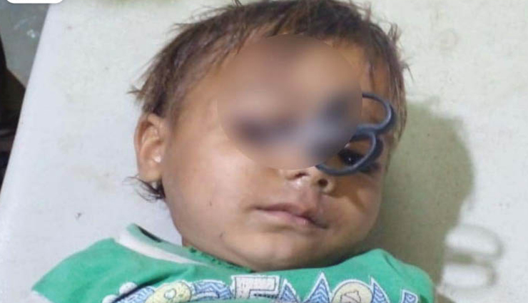नागौर : 6 सेंटीमीटर अंदर तक घुसी 3 साल के बच्चे की आंख में कैंची, ऑपरेशन के बाद बच्चा सही-सलामत