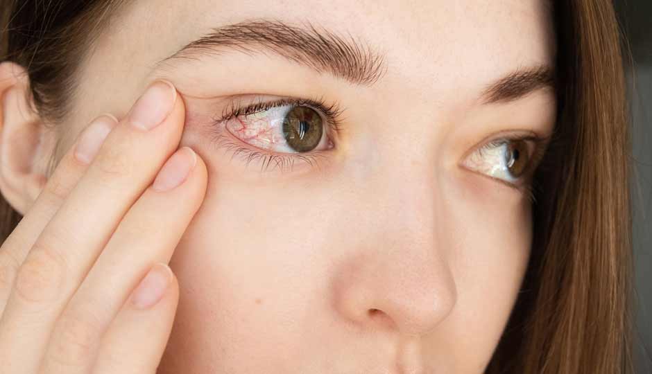 7 Home Remedies To Treat Irritation in Eyes