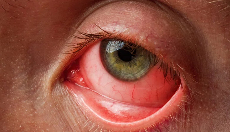 बारिश में बना रहता है इन्फैक्शन का खतरा, बचाव के लिए करें ये उपाय infection risk during rainy season,monsoon infection prevention tips,how to prevent infections in rainy season,rainy season health tips,protect yourself from infections in monsoon,monsoon infection safety measures,infection prevention in rainy weather,rainy season health precautions,stay safe from infections in monsoon,rainy season hygiene tips