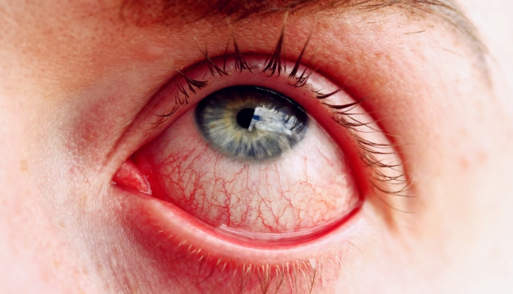 आंखों में दिख रहे ये लक्षण तो हो सकते हैं Omicron से संक्रमित, नजरअंदाज करना हो सकता है घातक