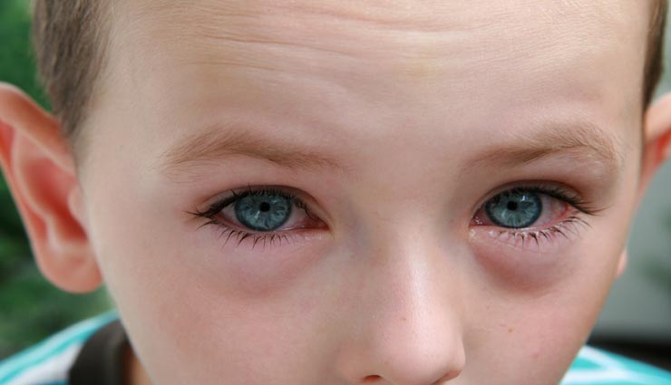 ये देसी नुस्खे दिलाएंगे आंखों में सूजन व जलन से राहत Health tips,health tips in hindi,home remedies,eyes irritation,eyes swelling,lockdown,coronavirus