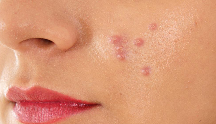 4 DIY Masks To Get Rid of Face Acne