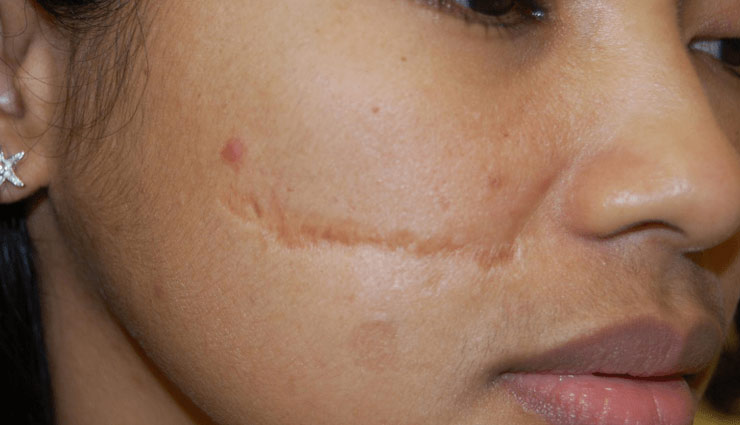 beauty tips,tips to remove injury marks,clear skin ,साफ़ त्वचा, ब्यूटी टिप्स, निशानमुक्त त्वचा, चोट के निशान 