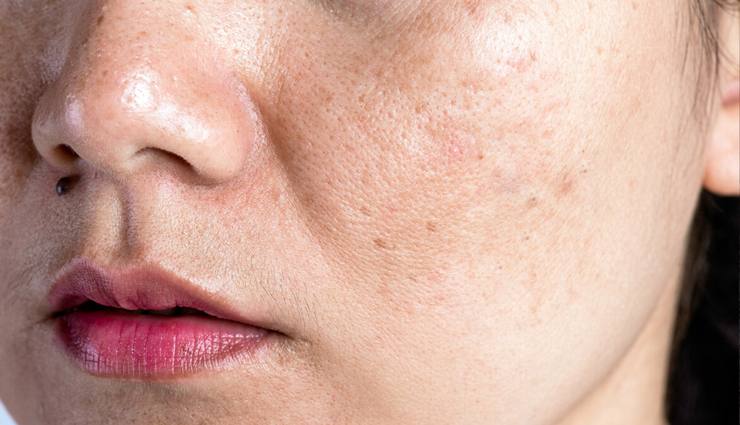 Get Rid of Face Pigmentation With These 5 Homemade Face Packs