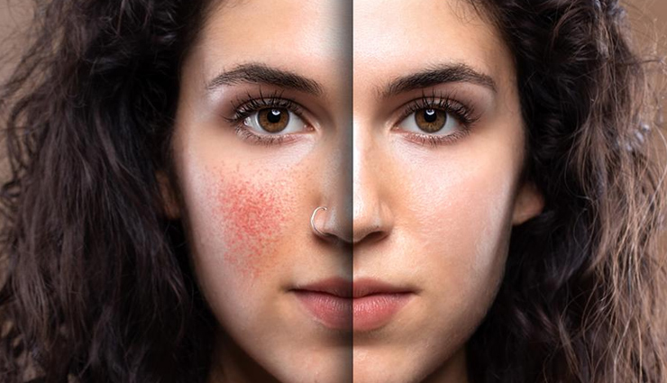 home remedies,home remedies for face redness,face care tips,summer sin care tips,skin care tips,beauty tips