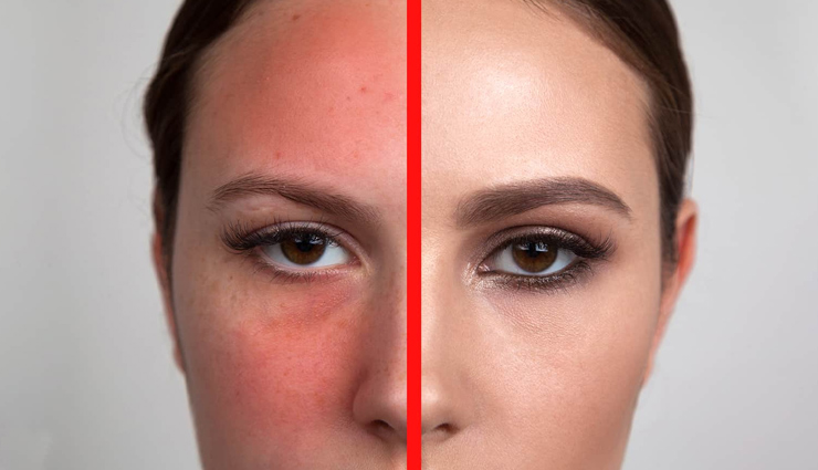 5 Home Remedies To Reduce Face Redness