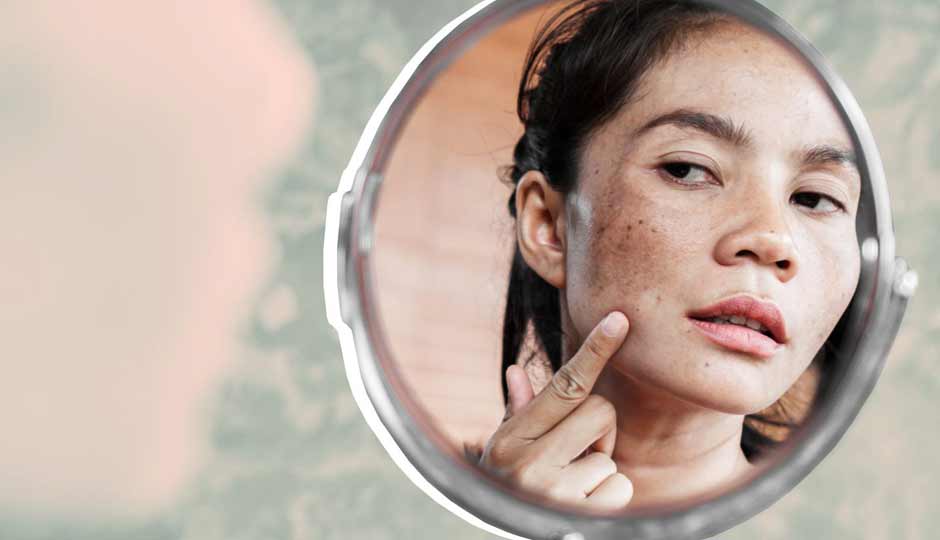 5 Effective Home remedies for Facial Darkness