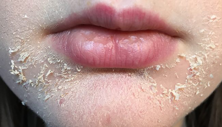 6 Effective Home Remedies For Flaky Skin