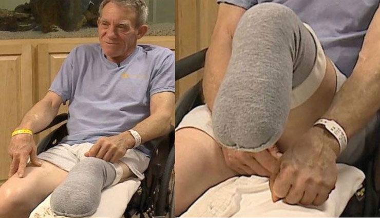 फसल काटने वाली मशीन में फंस गया था पैर, किसान ने खुद ही काट डाला चाकू से 