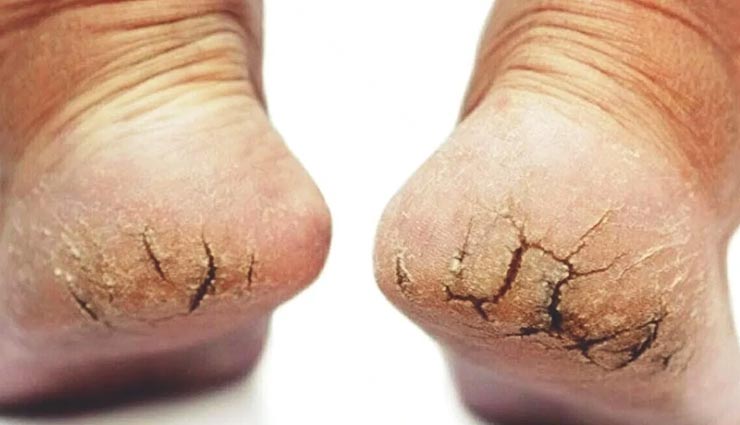 फटी एडियों से निजात दिलाएँगे ये उपाय, मिनटों में दिखने लगेगा असर