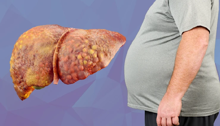 10 Amazing Home Remedies To Treat Fatty Liver