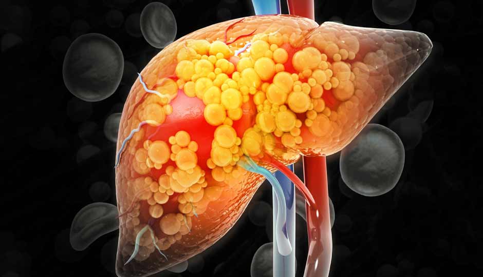 8 Home Remedies To Support Fatty Liver