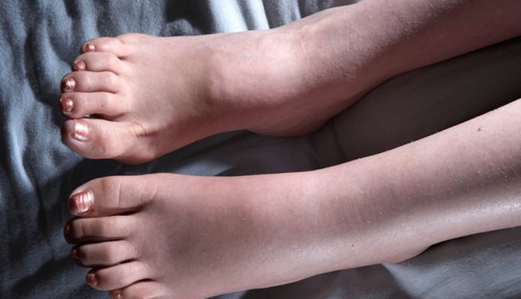 पैरों की सूजन से है परेशान, इन घरेलू उपचारों से दूर होगी समस्या 