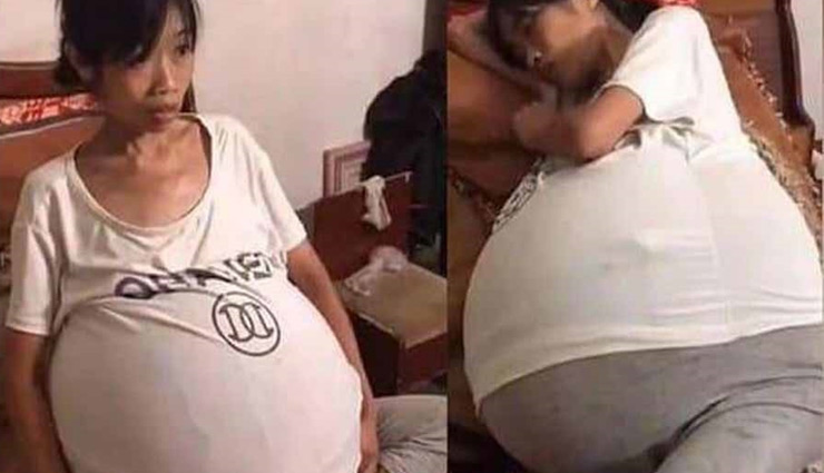 चीनी महिला का दो साल में पेट बढ़कर हुआ 19 किलो का, सोना और चलना-फिरना मुश्किल, डॉक्टर्स हैरान