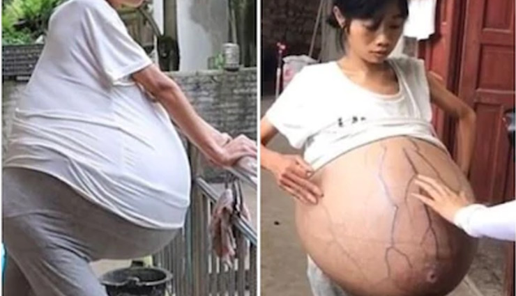 china,woman,stomach,weird news ,चीनी महिला,पेट 
