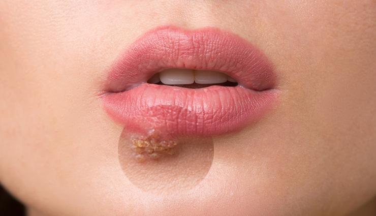 5 Home Remedies To Get Rid of Fever Blisters